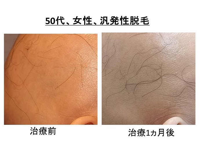 円形脱毛症　病院